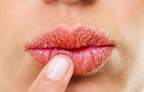 Почему трескаются губы посередине. Факторы, провоцирующие появление трещин на губах